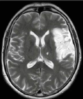 mri stroke